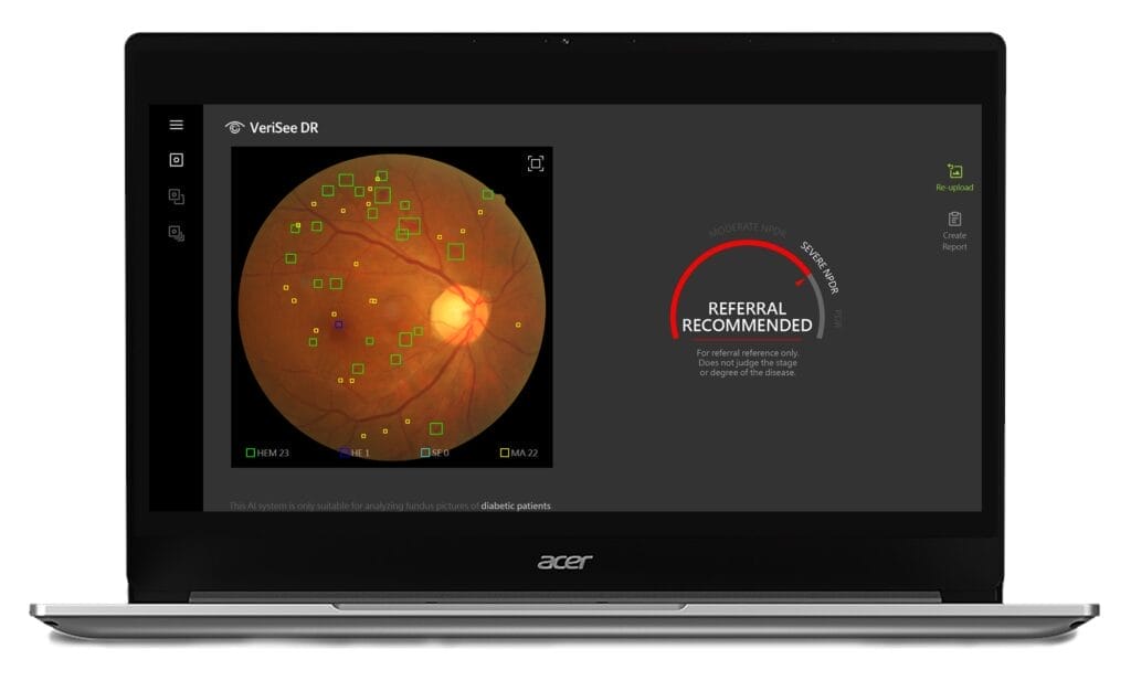 Acer Medical Inc. ร่วมกับ 4 โรงพยาบาล ทดลองใช้งาน Verisee DR ซอฟต์แวร์ วินิจฉัยภาวะเสี่ยงของโรคเบาหวานขึ้นจอประสาทตา  